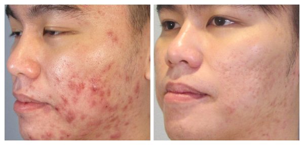 XÓA THÂM MỜ SẸO