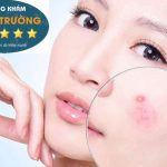 Hình ảnh: Làn da bị tổn thương do mụn trứng cá để lại