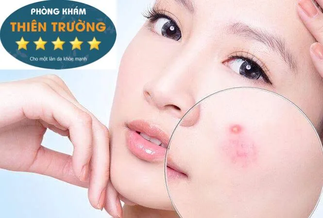 Hình ảnh: Làn da bị tổn thương do mụn trứng cá để lại