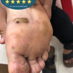 Hình ảnh mụn hạt cơm ở lòng bàn chân