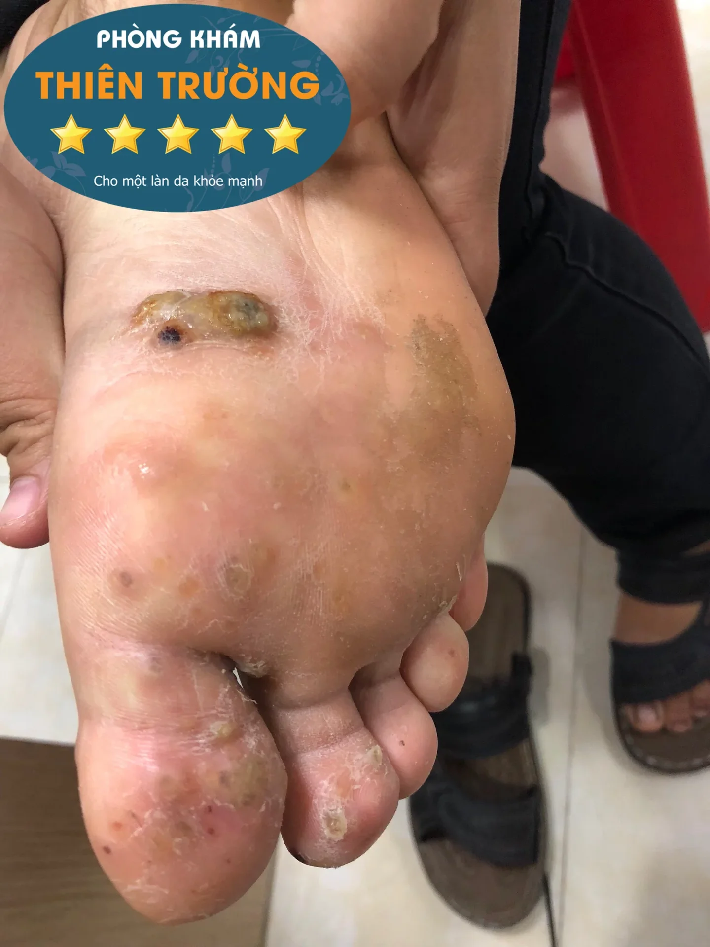 Hình ảnh: Mụn hạt cơm ở lòng bàn chân