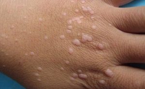 Hình ảnh : Hạt cóc phẳng