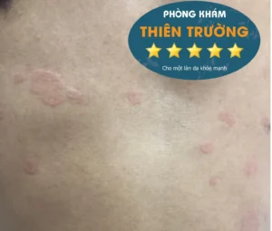 Hình ảnh: Bệnh mề đay xuất hiện trên da