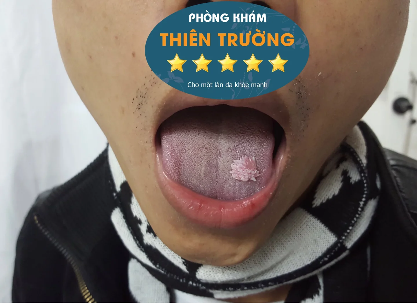 Hình ảnh: Sùi mào gà ở miệng