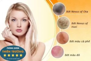 Hình ảnh: Bớt sắc tố trên da mặt Hình ảnh: Bớt sắc tố