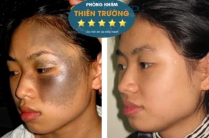 Hình ảnh: Khách hàng hỗ trợ điều trị bớt sắc tố