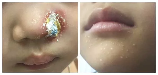 Hình ảnh: Chốc ở trẻ nhỏ