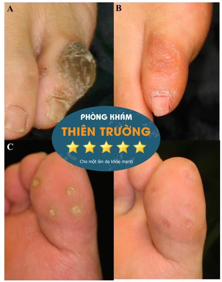 Hình ảnh: Hạt cơm, mụn cóc 