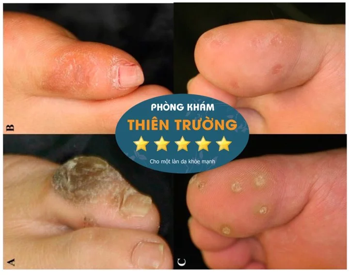 Hình ảnh: Ảnh trước và sau khi điều trị hạt cơm bằng công nghệ laser CO2 Fractional