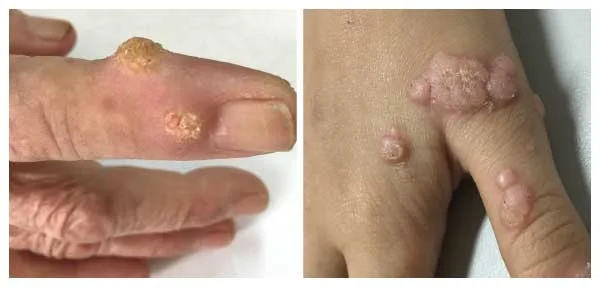 Hình ảnh: Mụn cóc sinh dục ở chân.