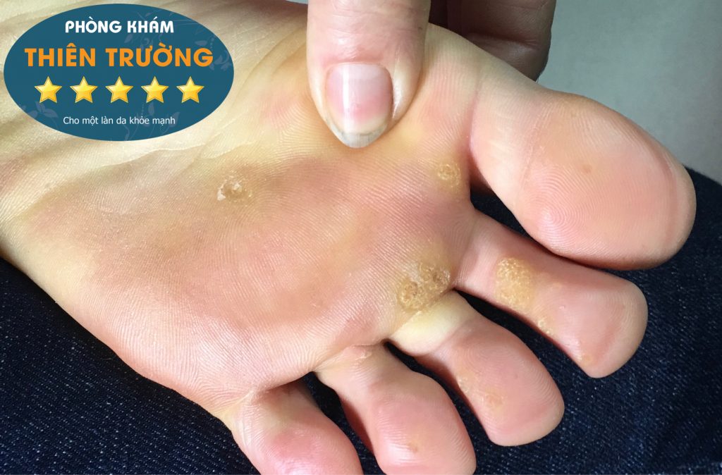 Hình ảnh: Hạt cơm ở chân.