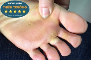 Hình ảnh: Hạt cơm ở chân.