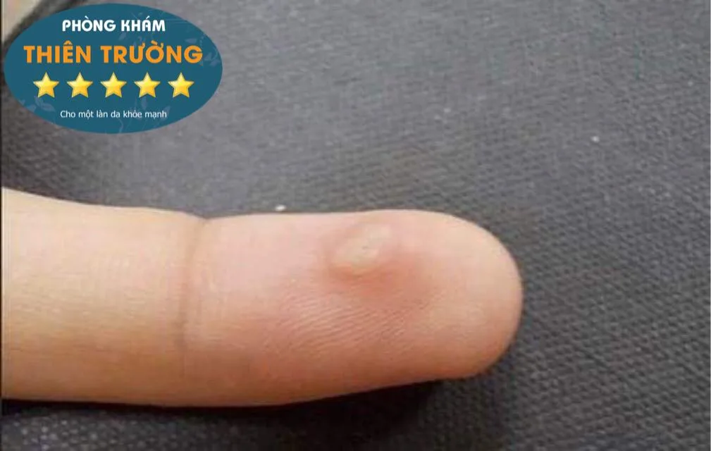 Hình ảnh : Hạt cơm bàn tay.