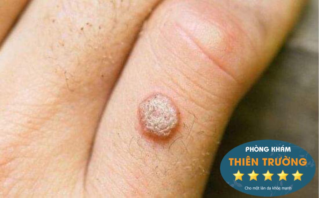 Hình ảnh : Hạt cơm ở bàn tay.