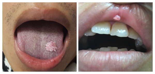 SÙI MÀO GÀ Ở MIỆNG