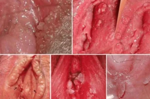 Hình ảnh: Bệnh sùi mào gà ở nữ giới