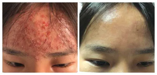 Khách hàng sau khi điều trị mụn trứng cá
