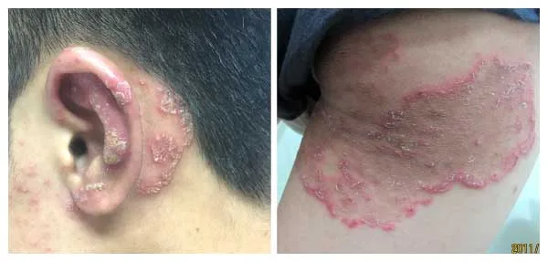 Hình ảnh : Nấm da.