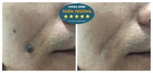 Hình ảnh khách hàng sau khi tẩy nốt ruồi bằng công nghệ Laser CO2