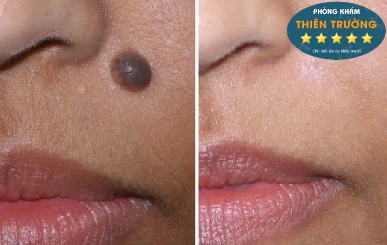 Hình ảnh : Khách hàng trước và sau khi điều trị nốt ruồi.