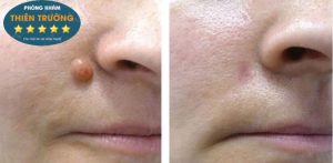 Hình ảnh khách hàng sau khi tẩy nốt ruồi bằng công nghệ Laser CO2