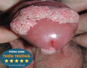 Hình ảnh: Bệnh sùi mào gà ở nam giới
