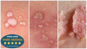 giai đoạn của sùi mào gà