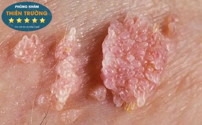 Hình ảnh: U nhú sinh dục