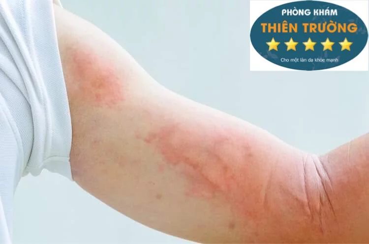 Hình ảnh: Bệnh nổi mề đay