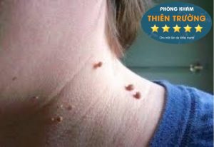 Hình ảnh: u mềm treo ở cổ