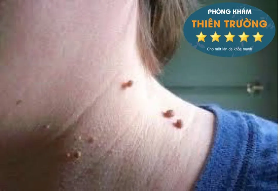 Hình ảnh: u mềm treo ở cổ