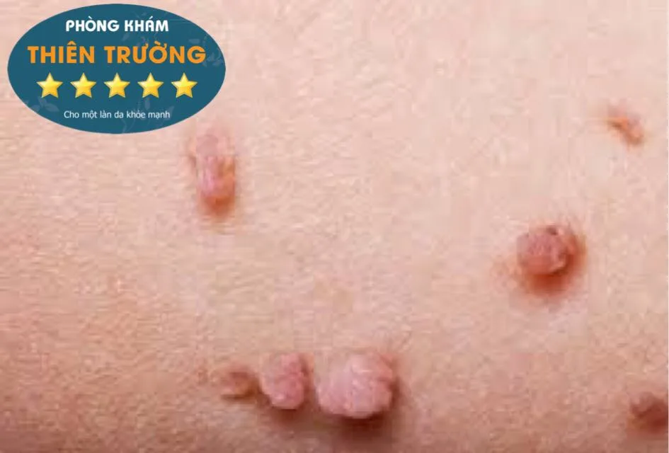 Hình ảnh: u mềm treo