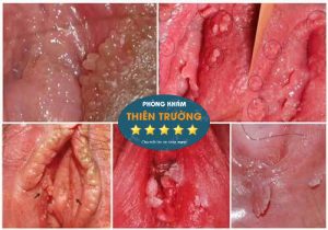 Nguyên Nhân U Nhú Sinh Dục - Da liễu Thiên Trường