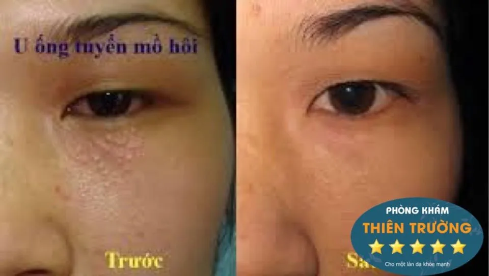 Hình ảnh: Trước và sau khi hỗ trợ điều trị u tuyến mồ hôi