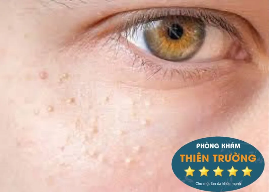 Hình ảnh. U tuyến mồ hôi