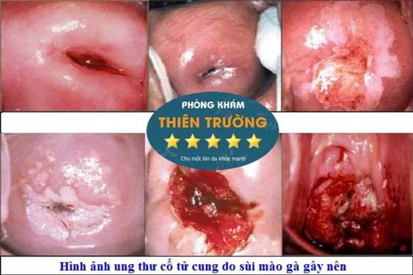 Hình ảnh: Ung thư cổ tử cung do sùi mào gà gây nên.