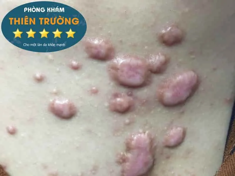 Hình ảnh: Sẹo lồi