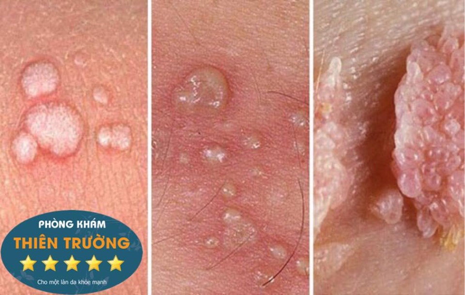 Hình ảnh: Virus HPV gây các bệnh vùng sinh dục