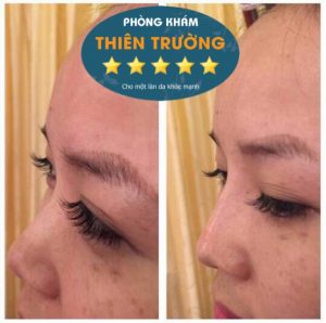 Hình ảnh: Ảnh khách hàng sau khi nâng mũi không phẫu thuật tại Phòng khám Da liễu Thẩm mỹ Thiên Trường