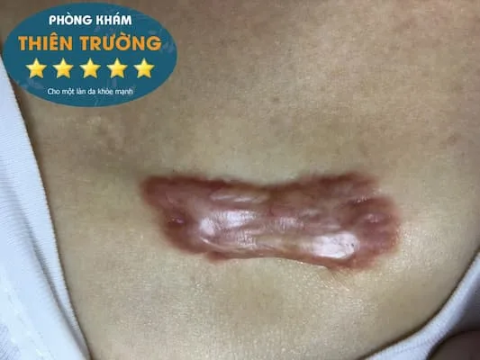 Hình ảnh: Sẹo lồi vùng ngực