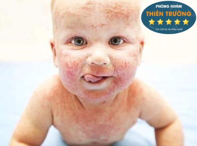 Hình ảnh: Viêm da cơ địa ở trẻ nhỏ