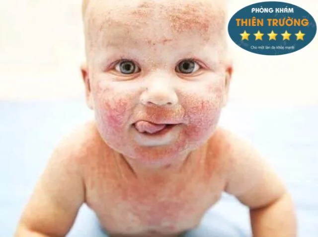 Hình ảnh: Viêm da cơ địa ở trẻ nhỏ