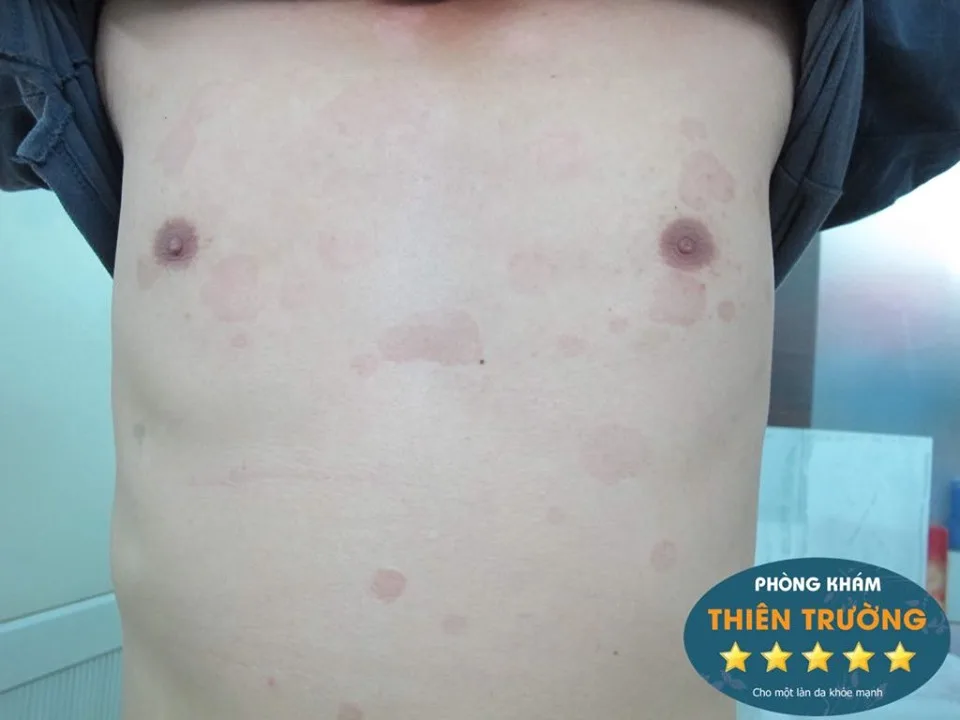 Hình ảnh :Dấu hiệu nấm da