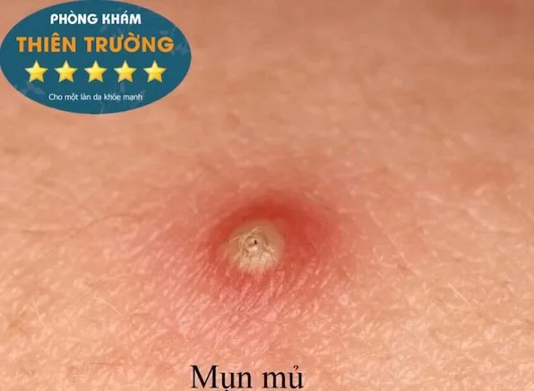 Hình ảnh: Mụn mủ