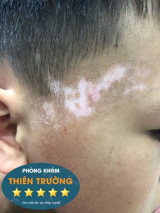 Hình ảnh: bệnh bạch biến