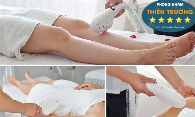 Hình ảnh: Triệt lông toàn thân