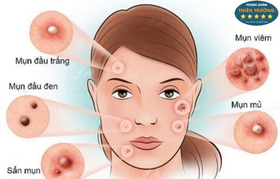 Hình ảnh: Các loại mụn có thể gặp trên da