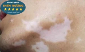 Hình ảnh: Bạch biến lan rộng khắp mặt, cổ 