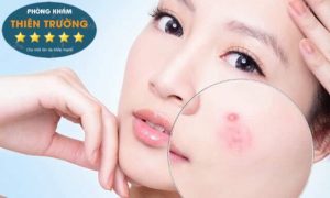 Hình ảnh: Mụn ẩn trên da.