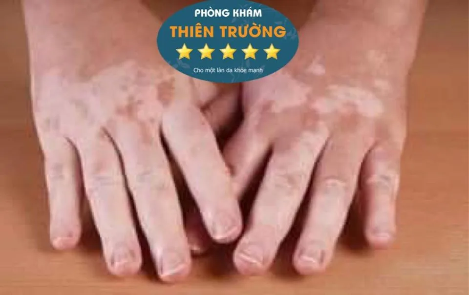 Hình ảnh: Bạch biến